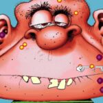 Acne Attack
